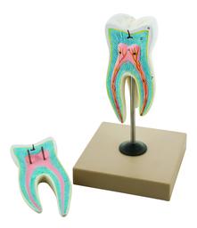 EISCO Upper Triple Root Molar with Caries Model, Enlarged 15 Times, 2 Parts