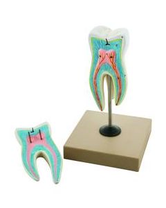 EISCO Upper Triple Root Molar with Caries Model, Enlarged 15 Times, 2 Parts