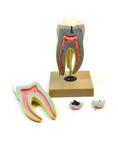 Eisco Labs Human Upper Triple Root Molar with interchangeable cavities - 6 parts